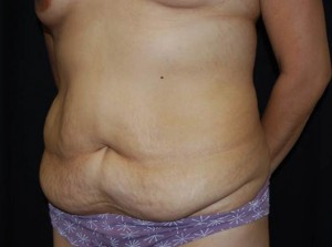 Tummy Tuck Before & After Patient #23166