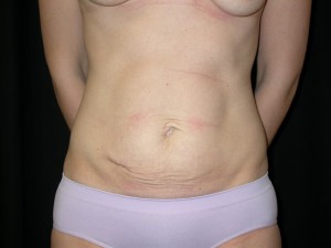 Tummy Tuck Before & After Patient #24286