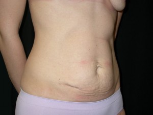 Tummy Tuck Before & After Patient #24286