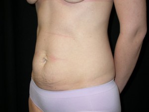 Tummy Tuck Before & After Patient #24286