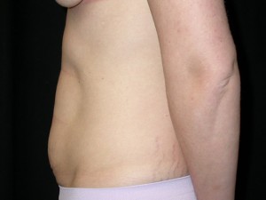 Tummy Tuck Before & After Patient #24286