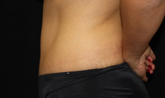 Tummy Tuck Before & After Patient #24307