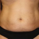 Tummy Tuck Before & After Patient #24307