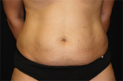 Tummy Tuck Before & After Patient #24307