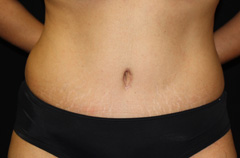 Tummy Tuck Before & After Patient #24307