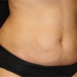 Tummy Tuck Before & After Patient #24307