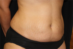 Tummy Tuck Before & After Patient #24307