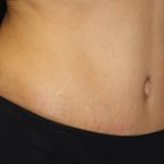 Tummy Tuck Before & After Patient #24307