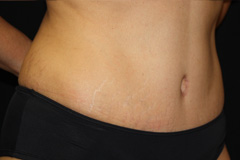 Tummy Tuck Before & After Patient #24307