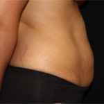 Tummy Tuck Before & After Patient #24307