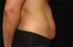 Tummy Tuck Before & After Patient #24307