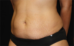 Tummy Tuck Before & After Patient #24307