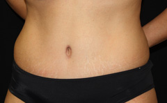 Tummy Tuck Before & After Patient #24307