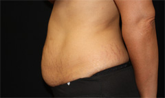 Tummy Tuck Before & After Patient #24307