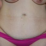 Tummy Tuck Before & After Patient #24308