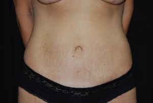 Tummy Tuck Before & After Patient #24308