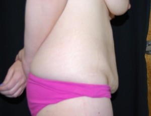 Tummy Tuck Before & After Patient #24308