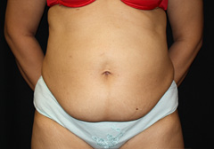 Tummy Tuck Before & After Patient #24329