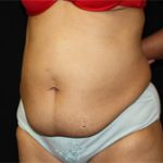 Tummy Tuck Before & After Patient #24329