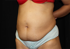 Tummy Tuck Before & After Patient #24329