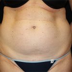 Tummy Tuck Before & After Patient #24330