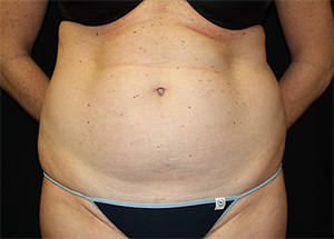 Tummy Tuck Before & After Patient #24330