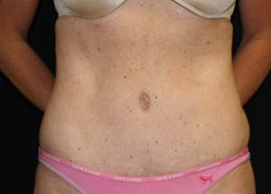 Tummy Tuck Before & After Patient #24330