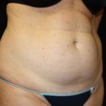 Tummy Tuck Before & After Patient #24330