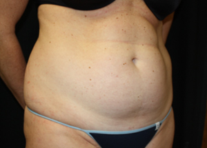Tummy Tuck Before & After Patient #24330