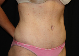 Tummy Tuck Before & After Patient #24330