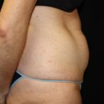 Tummy Tuck Before & After Patient #24330