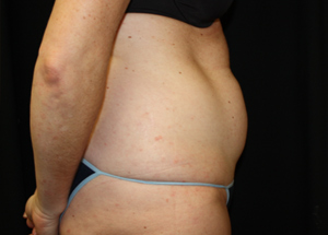 Tummy Tuck Before & After Patient #24330