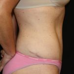 Tummy Tuck Before & After Patient #24330