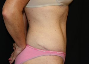 Tummy Tuck Before & After Patient #24330