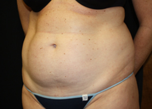 Tummy Tuck Before & After Patient #24330