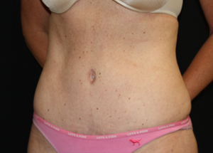 Tummy Tuck Before & After Patient #24330