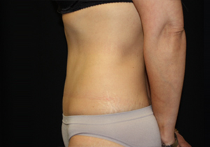 Tummy Tuck Before & After Patient #24347