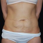 Tummy Tuck Before & After Patient #24347