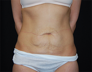 Tummy Tuck Before & After Patient #24347