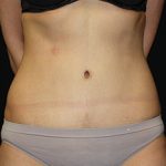 Tummy Tuck Before & After Patient #24347