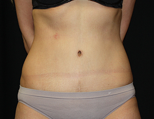 Tummy Tuck Before & After Patient #24347