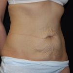 Tummy Tuck Before & After Patient #24347