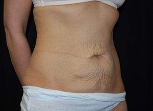 Tummy Tuck Before & After Patient #24347