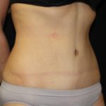 Tummy Tuck Before & After Patient #24347