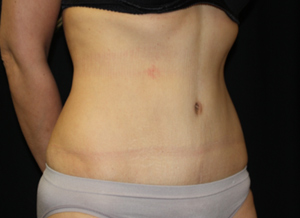 Tummy Tuck Before & After Patient #24347