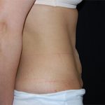 Tummy Tuck Before & After Patient #24347