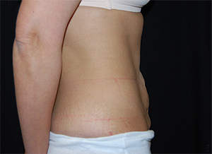 Tummy Tuck Before & After Patient #24347