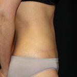 Tummy Tuck Before & After Patient #24347