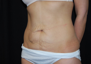 Tummy Tuck Before & After Patient #24347