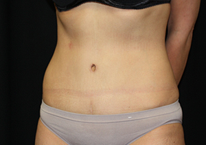 Tummy Tuck Before & After Patient #24347